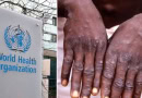 Who Approves First Vaccine For Mpox