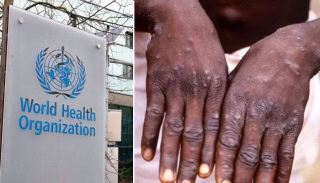 Who Approves First Vaccine For Mpox