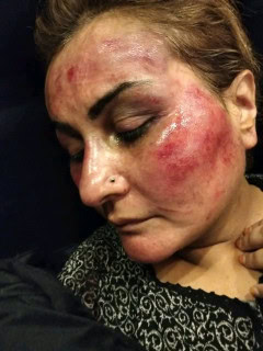 Former Stage Dancer Nargis Allegedly Assaulted By Husband 