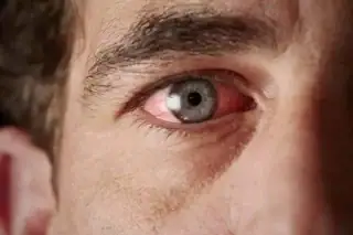 Viral Conjunctivitis Cases Surge In Islamabad Rawalpindi After Rains