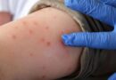 Measles Chickenpox And Mumps Cases Rise Among Children In Karachi