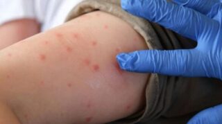 Measles Chickenpox And Mumps Cases Rise Among Children In Karachi